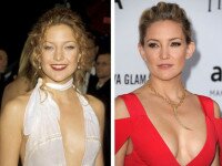 Kate Hudson boob job